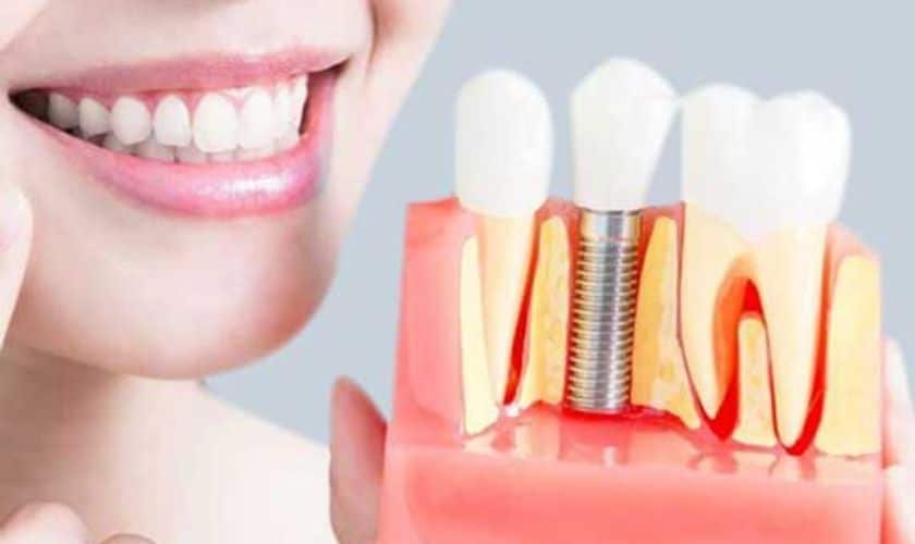 Dental Implants Puyallup