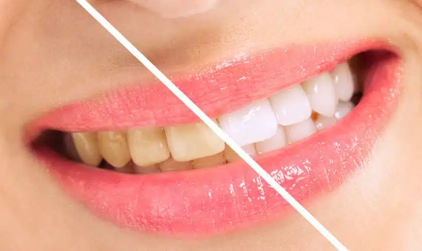 Teeth Whitening in Puyallup