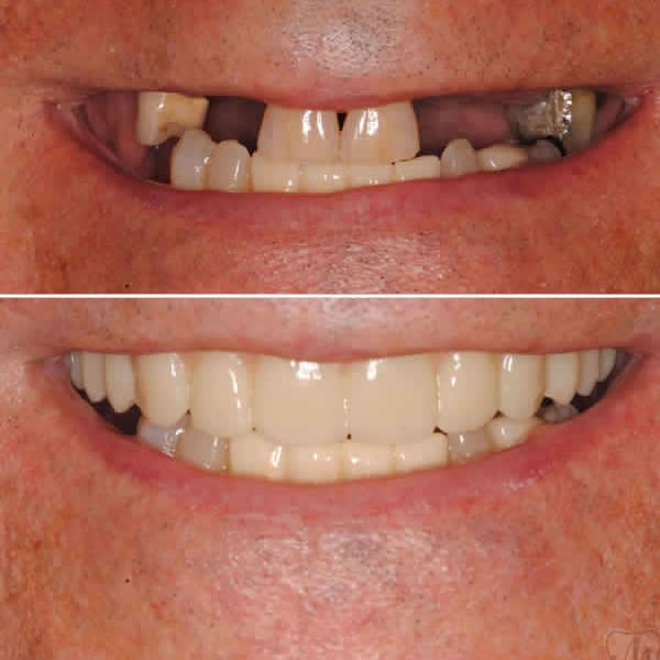 Best dental implants Puyallup