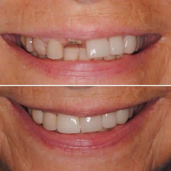 Dental Implant Solution