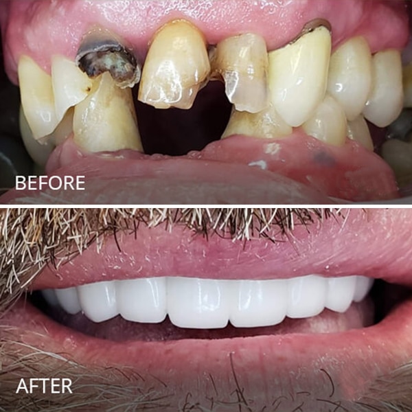 Dental Implant Treatment