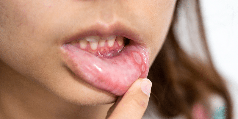 Dental Abscesses